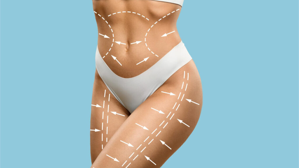 Pourquoi choisir la liposculpture pour remodeler sa silhouette ?